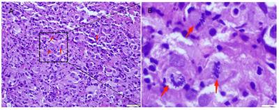 Dual immunotherapy alternating with anti-PD-1 antibody plus liposomal doxorubicin show good efficacy in prostate epithelioid hemangioendothelioma: a case report